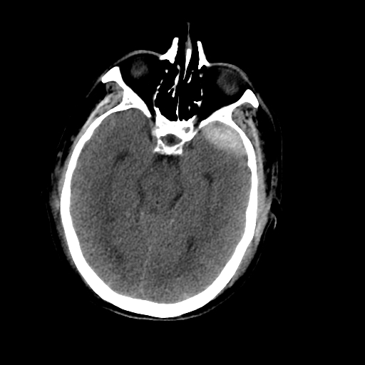 Epidural Hematoma Middle Meningeal Artery Fistula