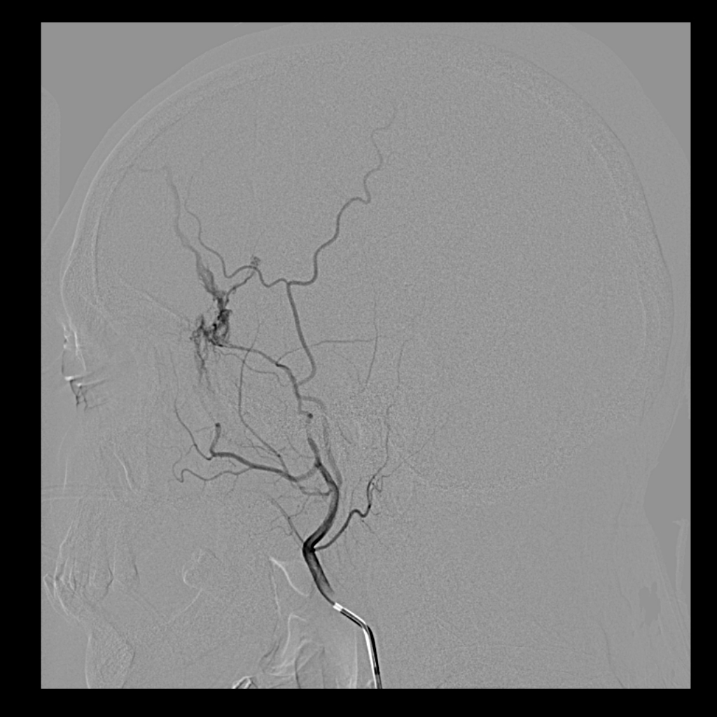 Epidural Hematoma Middle Meningeal Artery Fistula