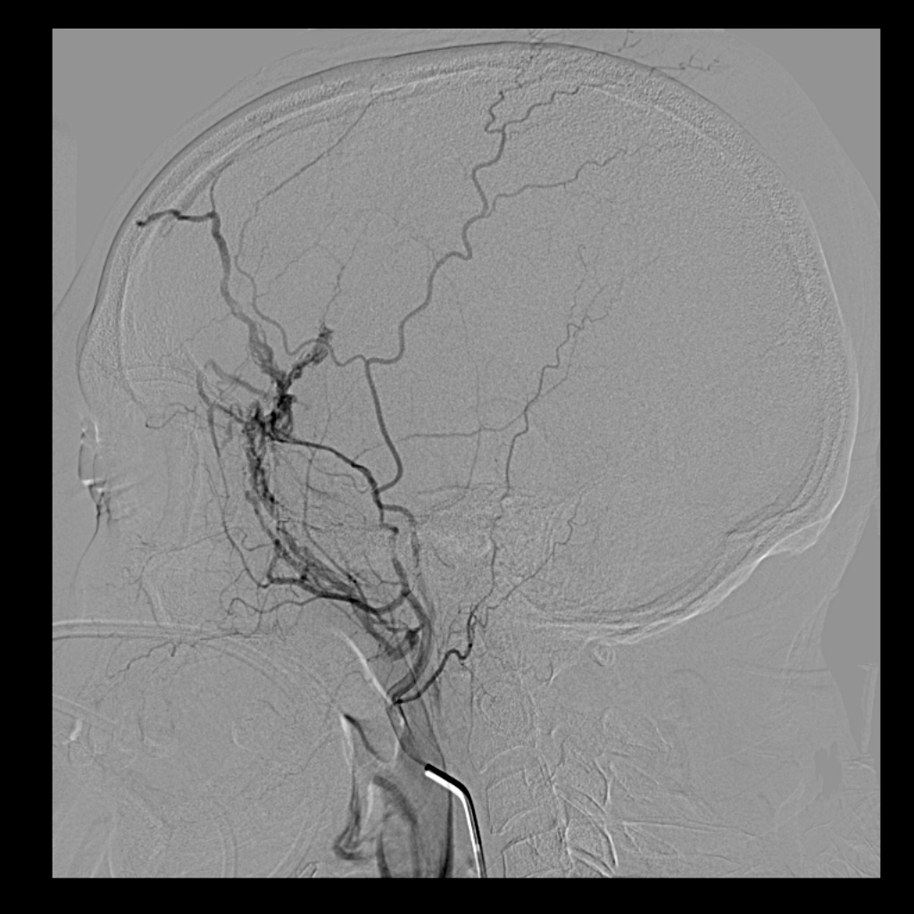 Epidural Hematoma MMA trauma