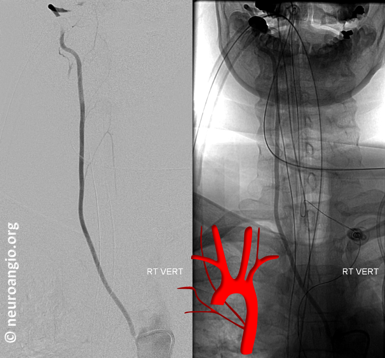 supreme intercostal aortic origin of right vertebral artery