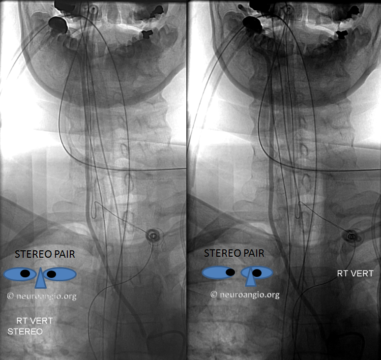 Supreme intercostal origin of right vertebral artery 