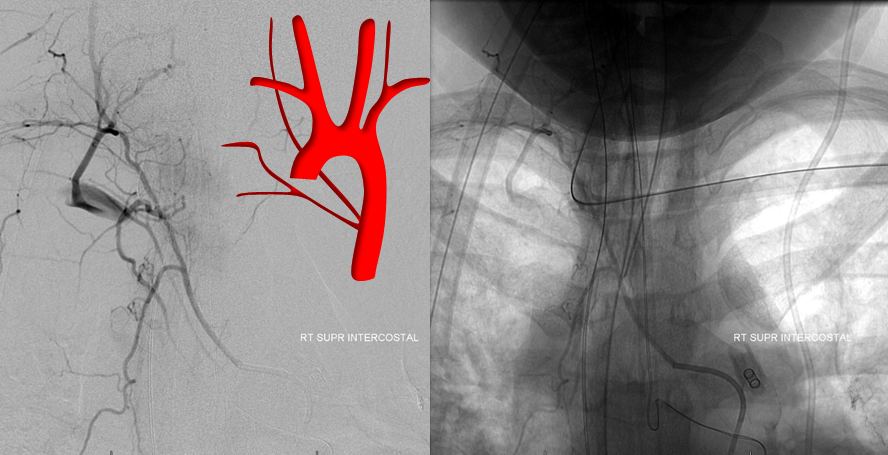Supreme intercostal origin vertebral artery