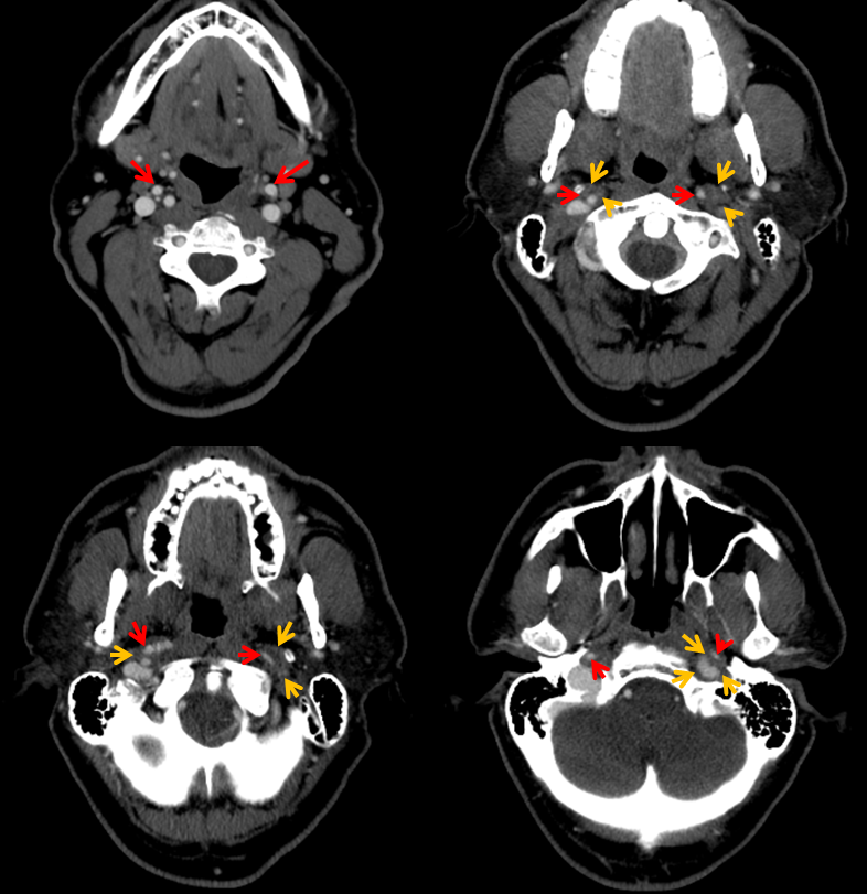 http://www.neuroangio.org/wp-content/uploads/Cases/Archives_Carotid_Dissection_LCN_1.png