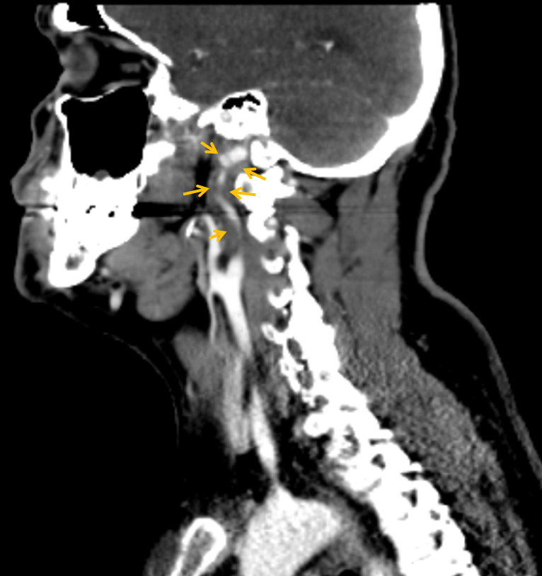 http://www.neuroangio.org/wp-content/uploads/Cases/Archives_Carotid_Dissection_LCN_2.png