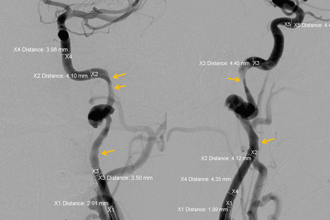 http://www.neuroangio.org/wp-content/uploads/Cases/Archives_Carotid_Dissection_LCN_3.png