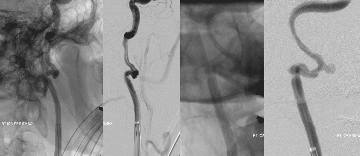 http://www.neuroangio.org/wp-content/uploads/Cases/Archives_Carotid_Dissection_LCN_5.png