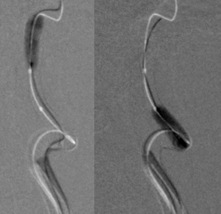 http://www.neuroangio.org/wp-content/uploads/Cases/Archives_Carotid_Dissection_LCN_6.png