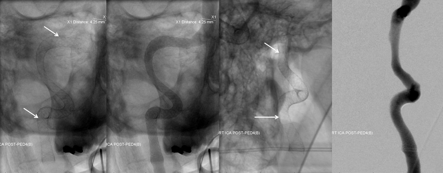 http://www.neuroangio.org/wp-content/uploads/Cases/Archives_Carotid_Dissection_LCN_7.png