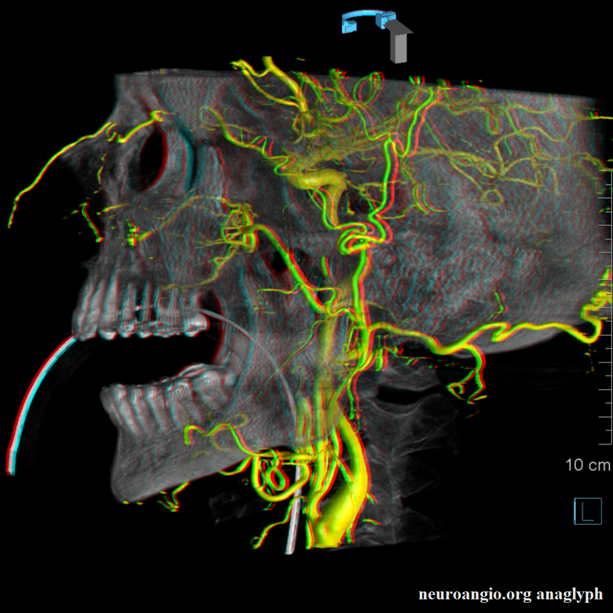Spinal Vascular Anatomy Neuroangio Org
