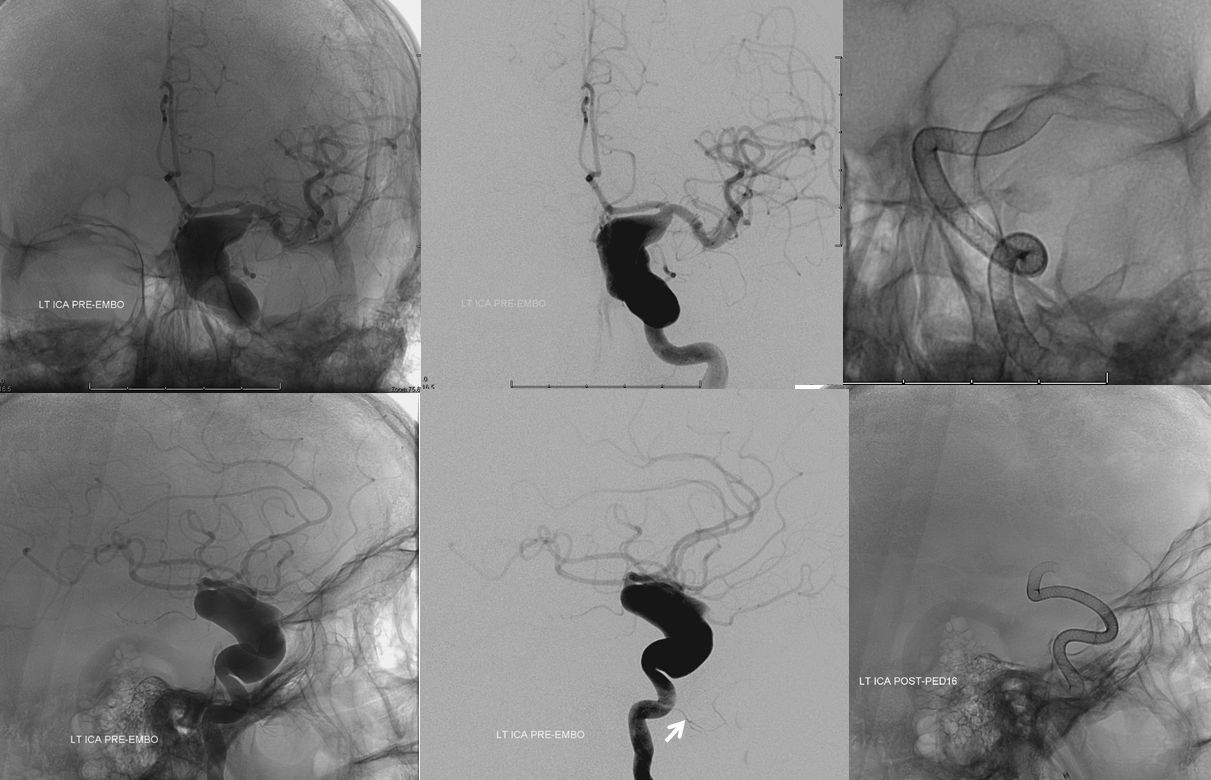 Intracranial carotid artery brain aneurysm