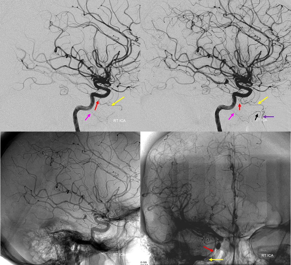 Artery of Foramen Rotundum from ILT
