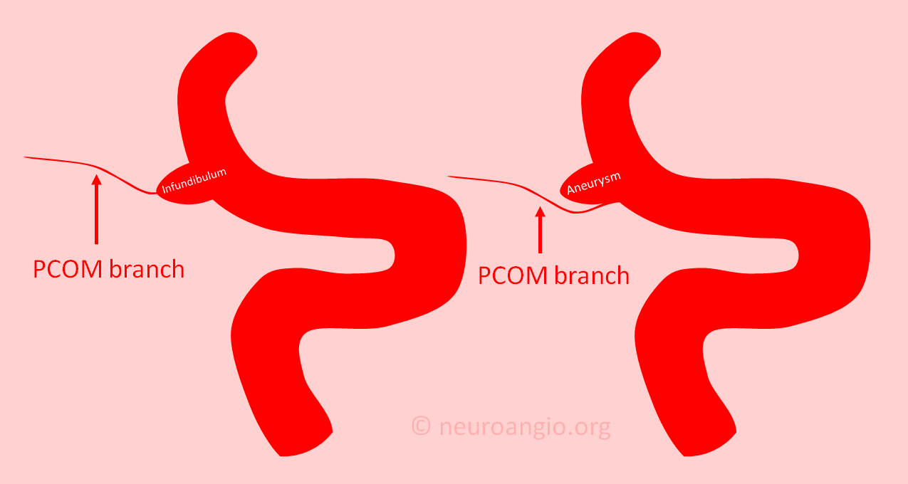 Infundibulum | neuroangio.org