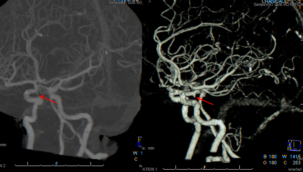 Cerebral Angiography Anatomy