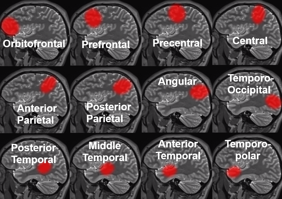 Spinal Vascular Anatomy Neuroangio Org