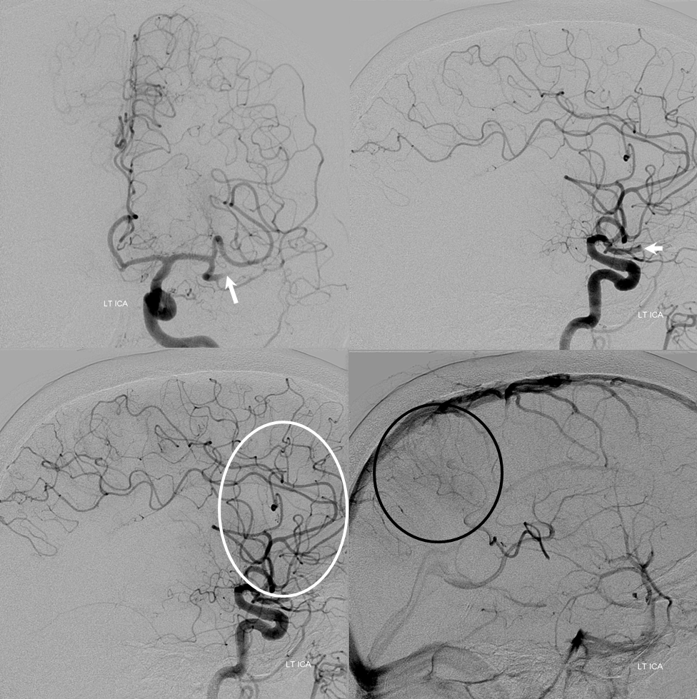 inferior division MCA stroke