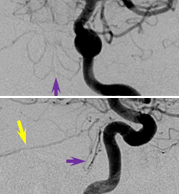 http://www.neuroangio.org/wp-content/uploads/MHT/MHT_lateral_tentorial_arcade_dural_fistula_clival_branches_3.png