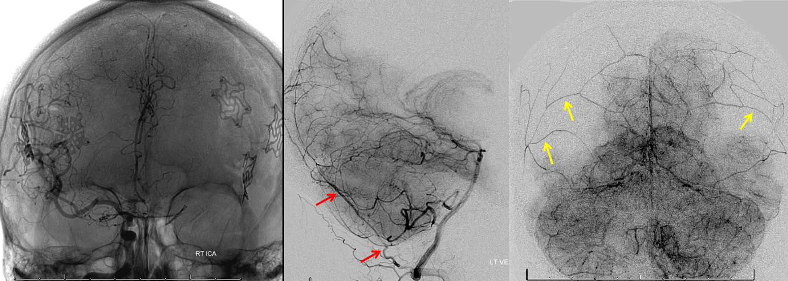 http://www.neuroangio.org/wp-content/uploads/MMA/MMA_bilateral_craniotomy_PMA.png