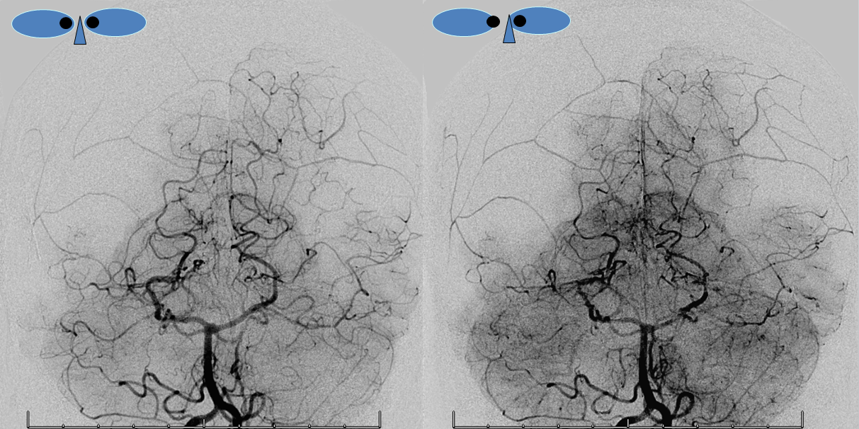 http://www.neuroangio.org/wp-content/uploads/MMA/MMA_bilateral_craniotomy_PMA_Stereo.png