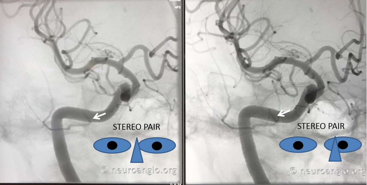 Persistent Stapedial Artery