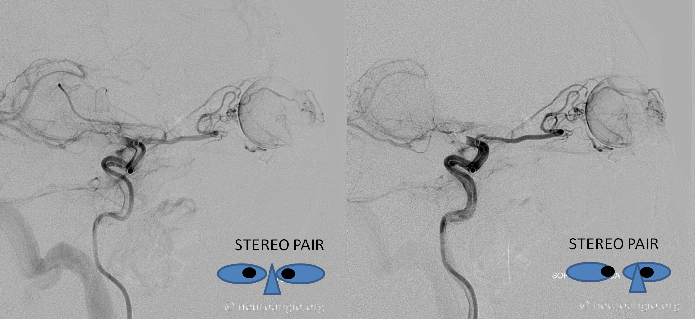 Ophthalmic stereo stroke