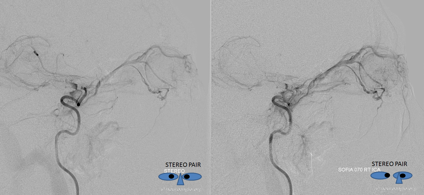 ophthamic artery stroke venous phase