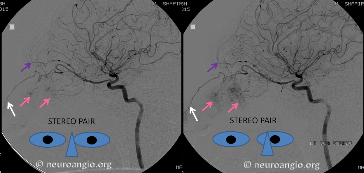 http://www.neuroangio.org/wp-content/uploads/Ophthalmic/Ophthalmic_stereo_nasal_supply.PNG