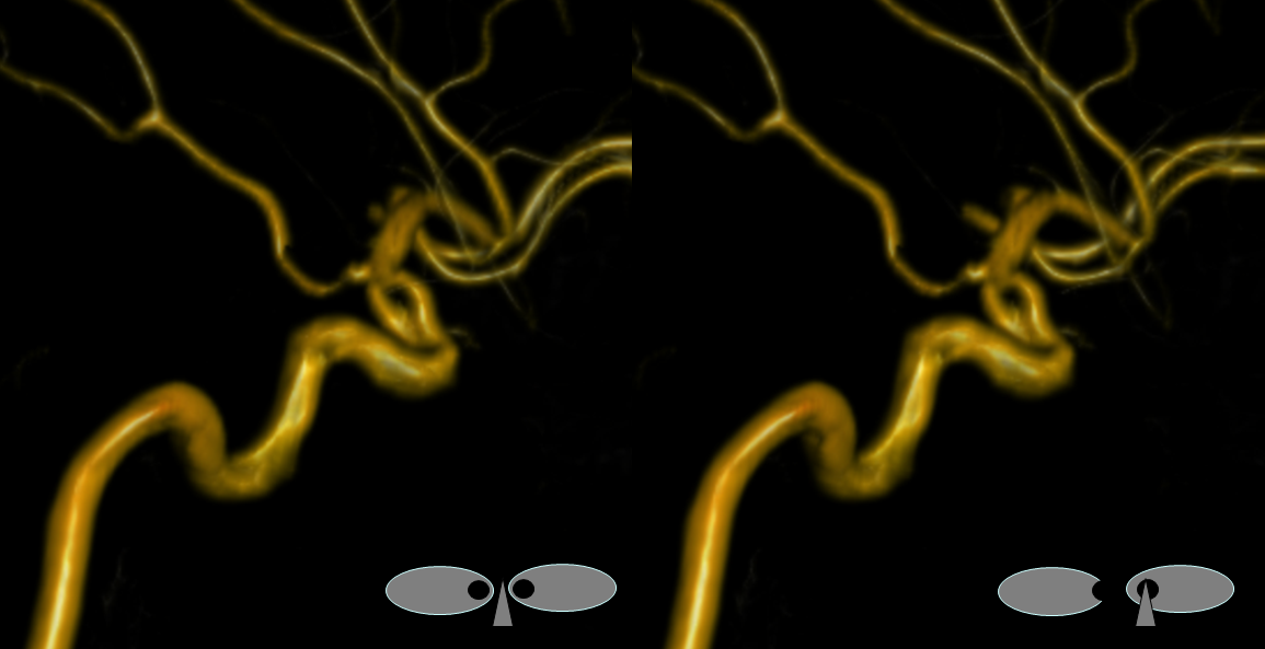 Supraclinoid Carotid Artery Fenestration