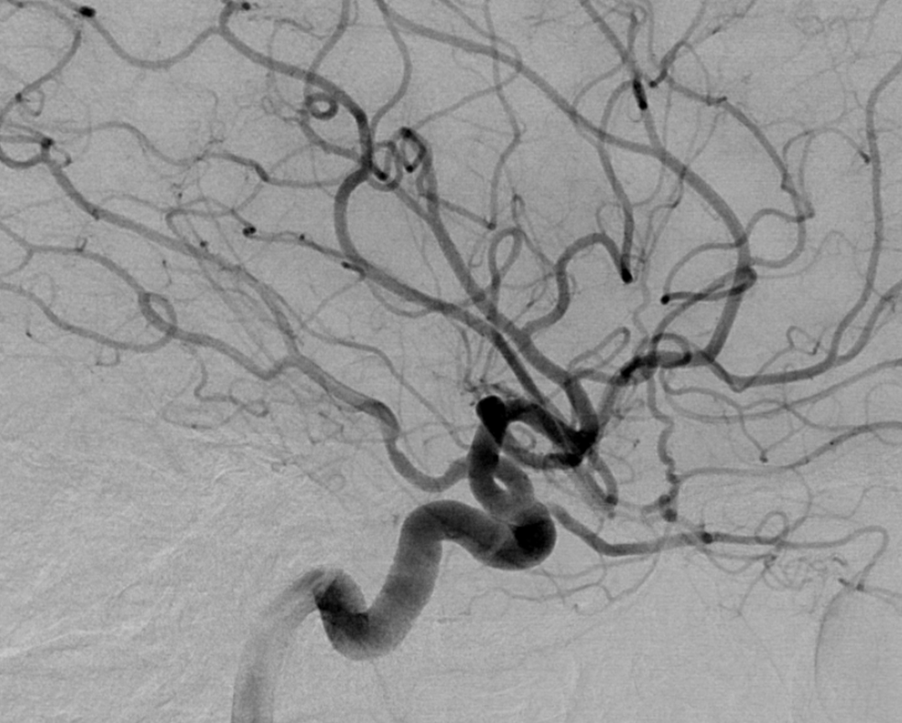 Supraclinoid Carotid Artery Fenestration