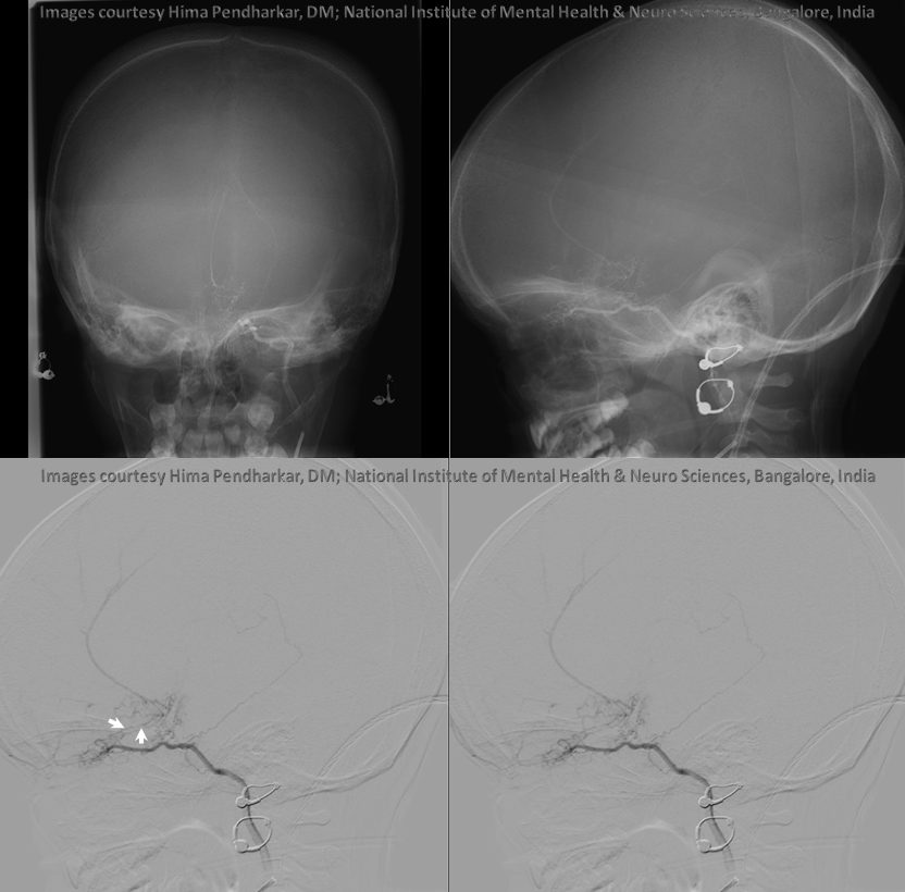 Ventral ophthalmic and marginal tentorial arteries