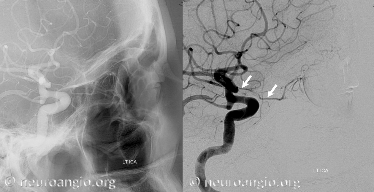 Ventral ophthalmic artery