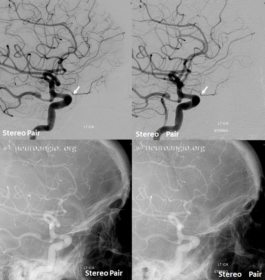 Ventral ophthalmic artery