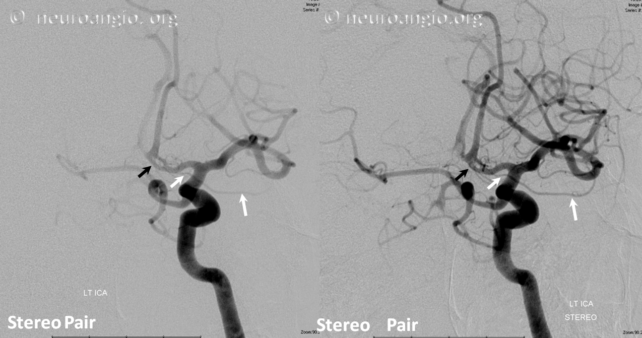 Ventral ophthalmic artery