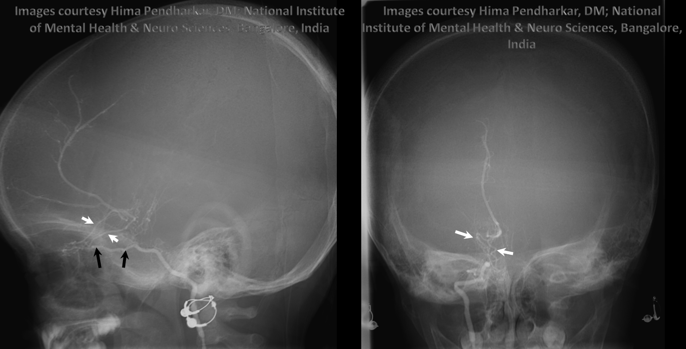 Ventral ophthalmic artery