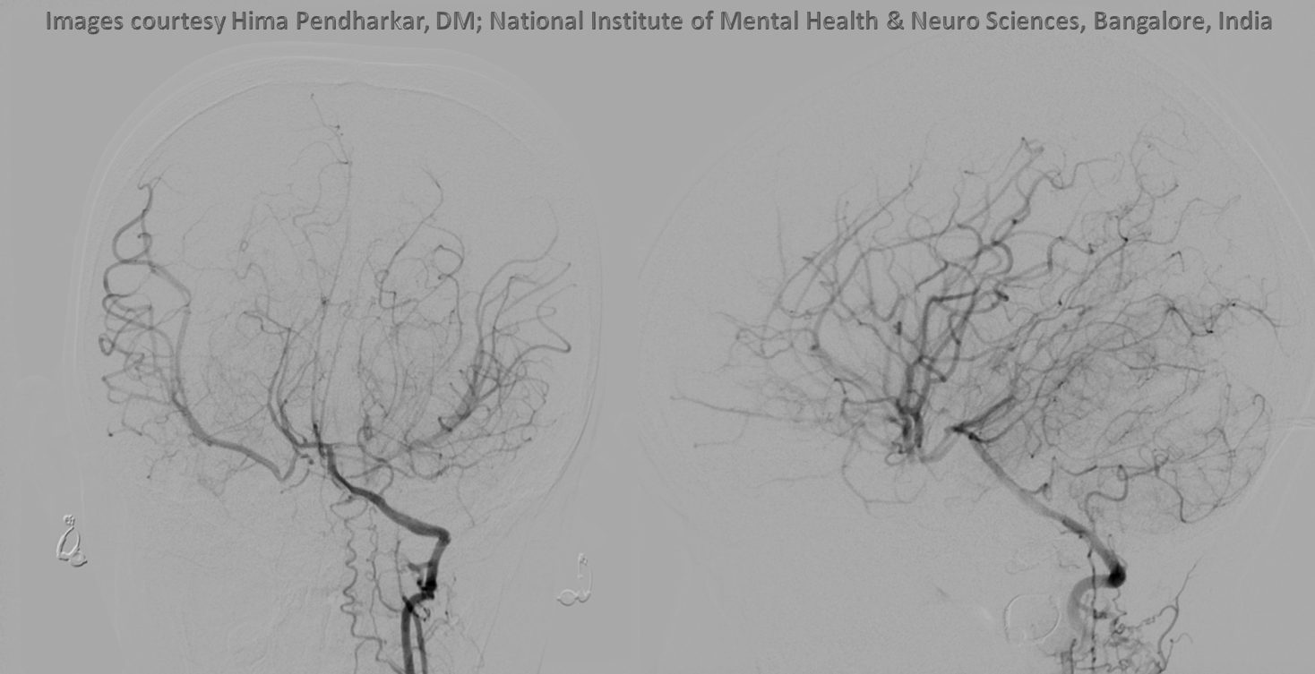 Moya Moya ventral ophthalmic vertebral artery