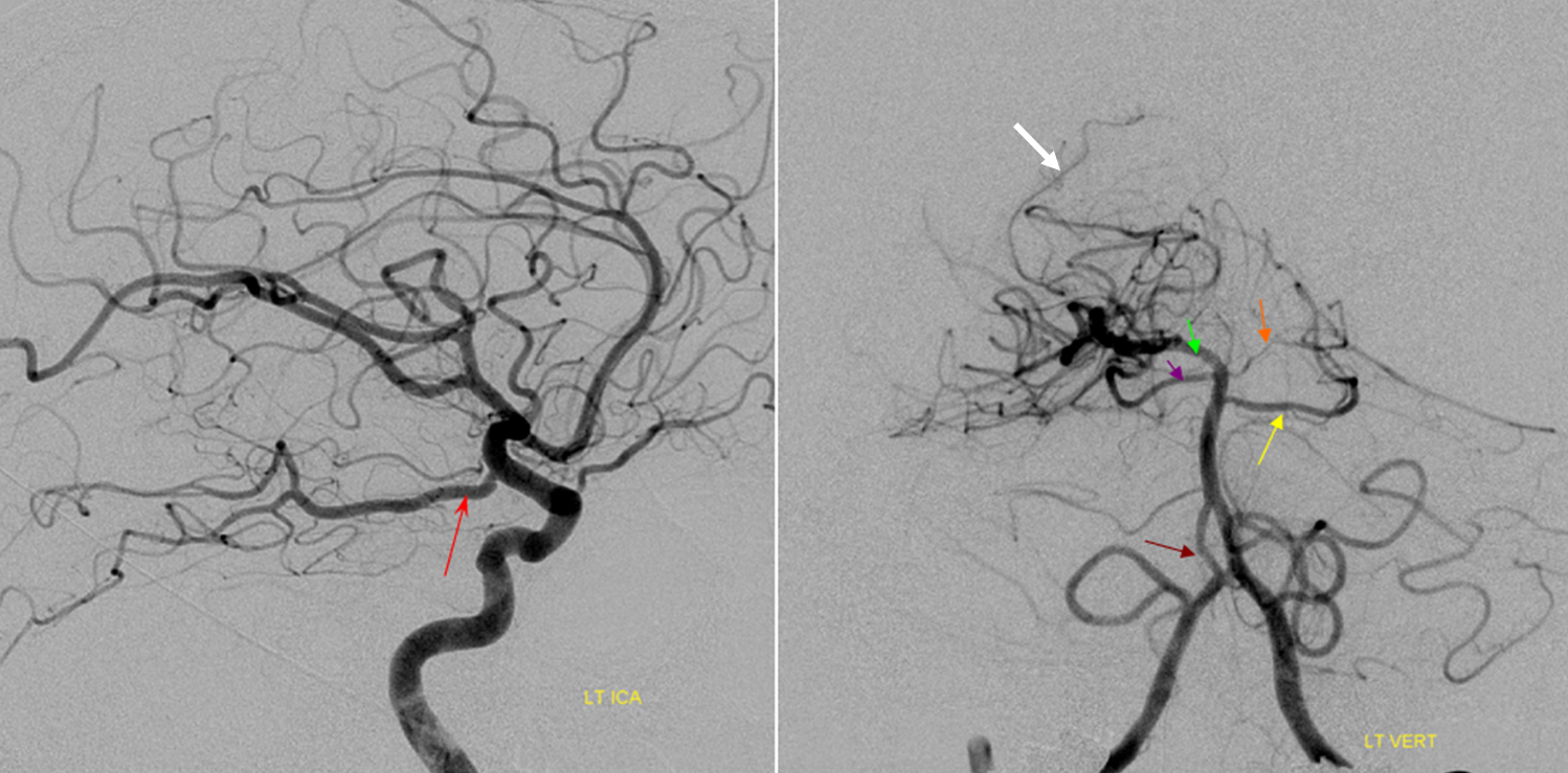 http://www.neuroangio.org/wp-content/uploads/PCA/PCA%20fetal%20PCOM%20angio.png