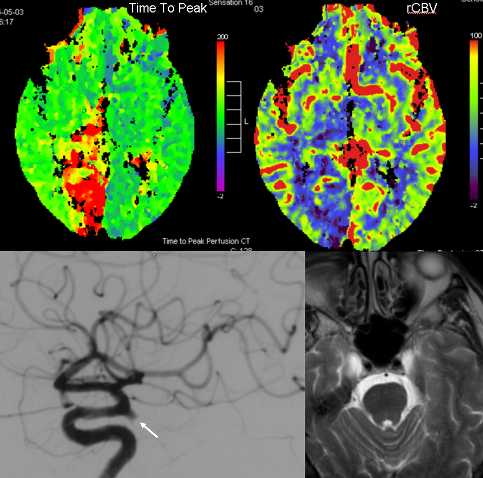 Embolic Stroke Fetal PCOM