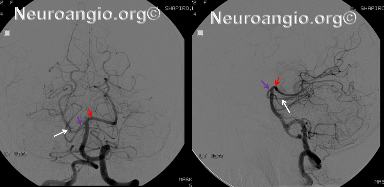 http://www.neuroangio.org/wp-content/uploads/PCA/PCA_01.png