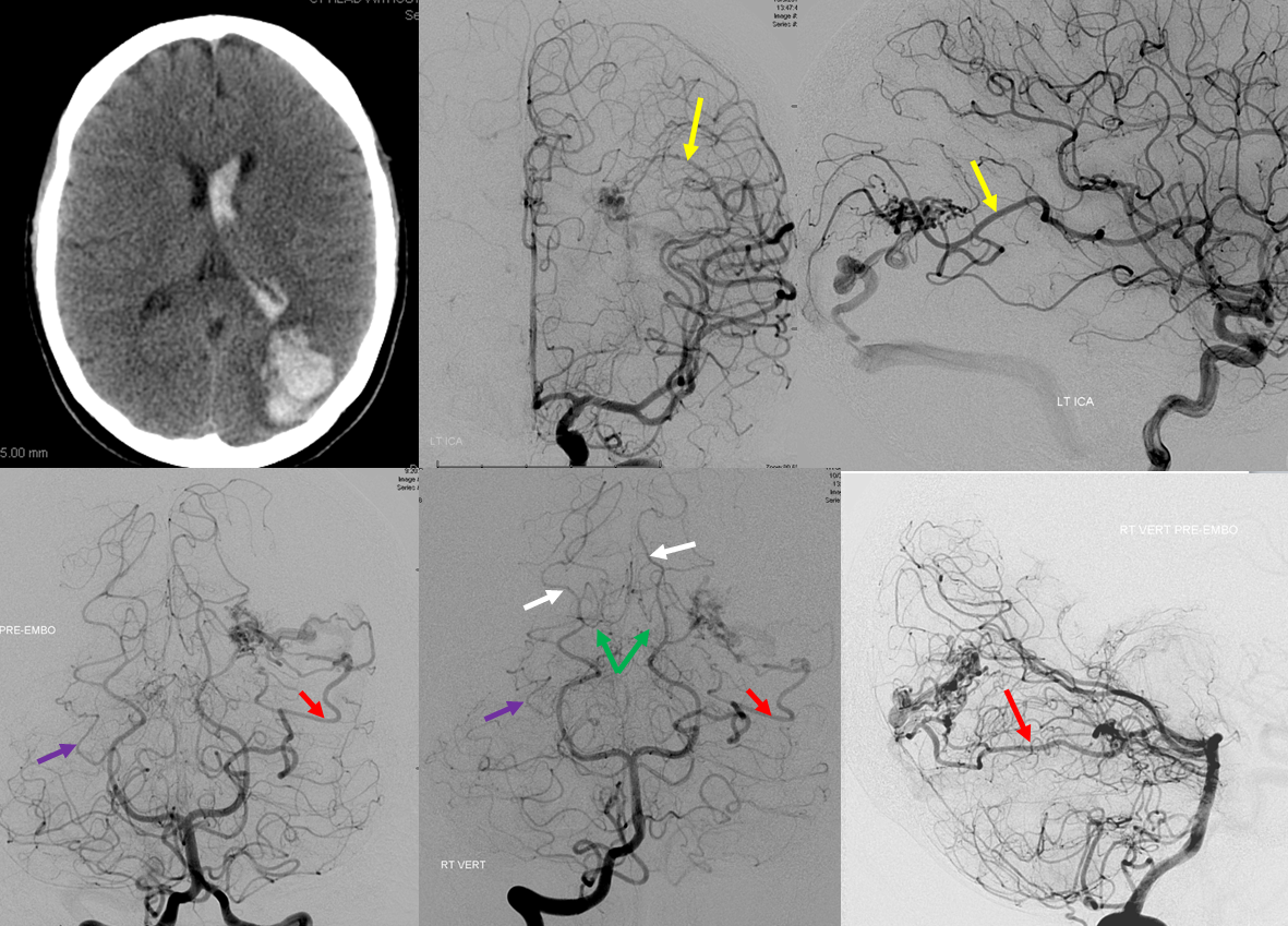 AVM inferior parietal