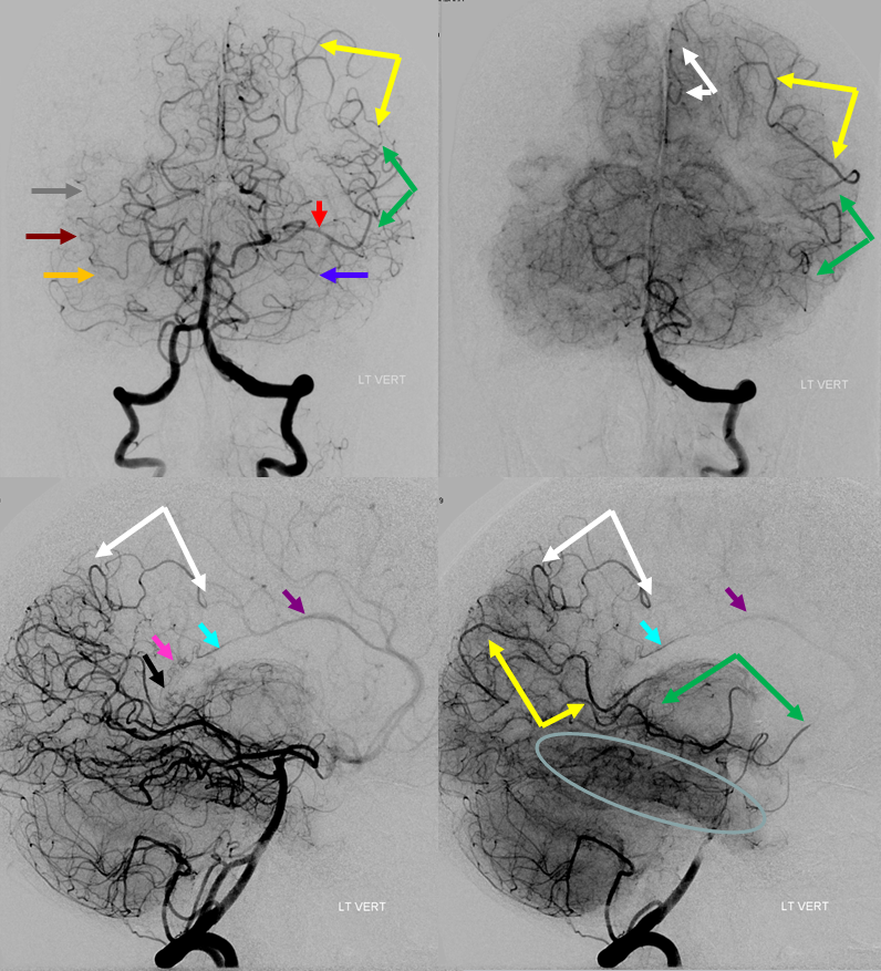 ICA occlusion PCA reconstitution