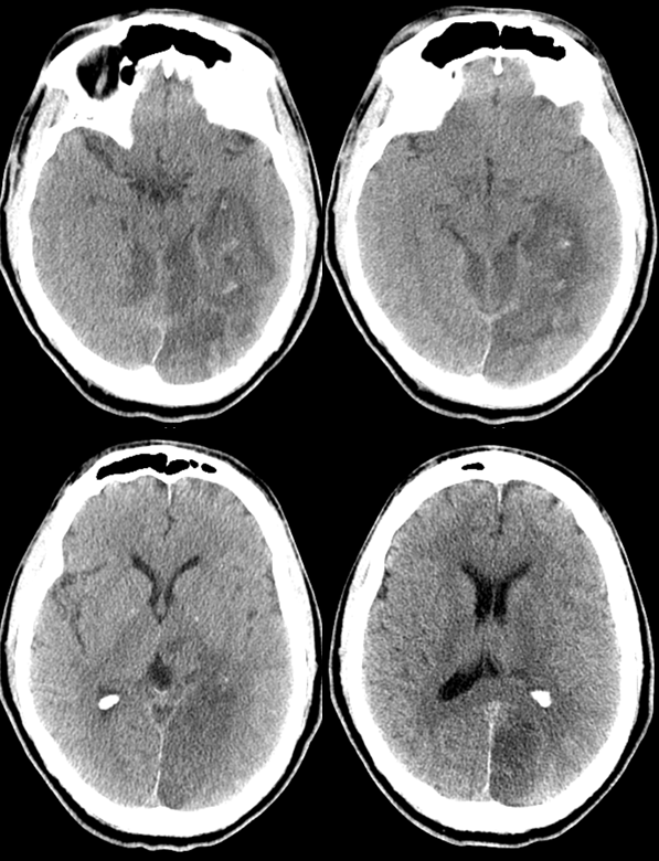 PCA stroke top of basilar occlusion