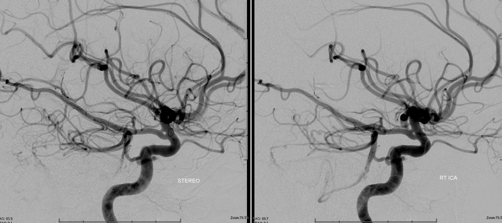 fenestrated PCOM posterior communicating artery