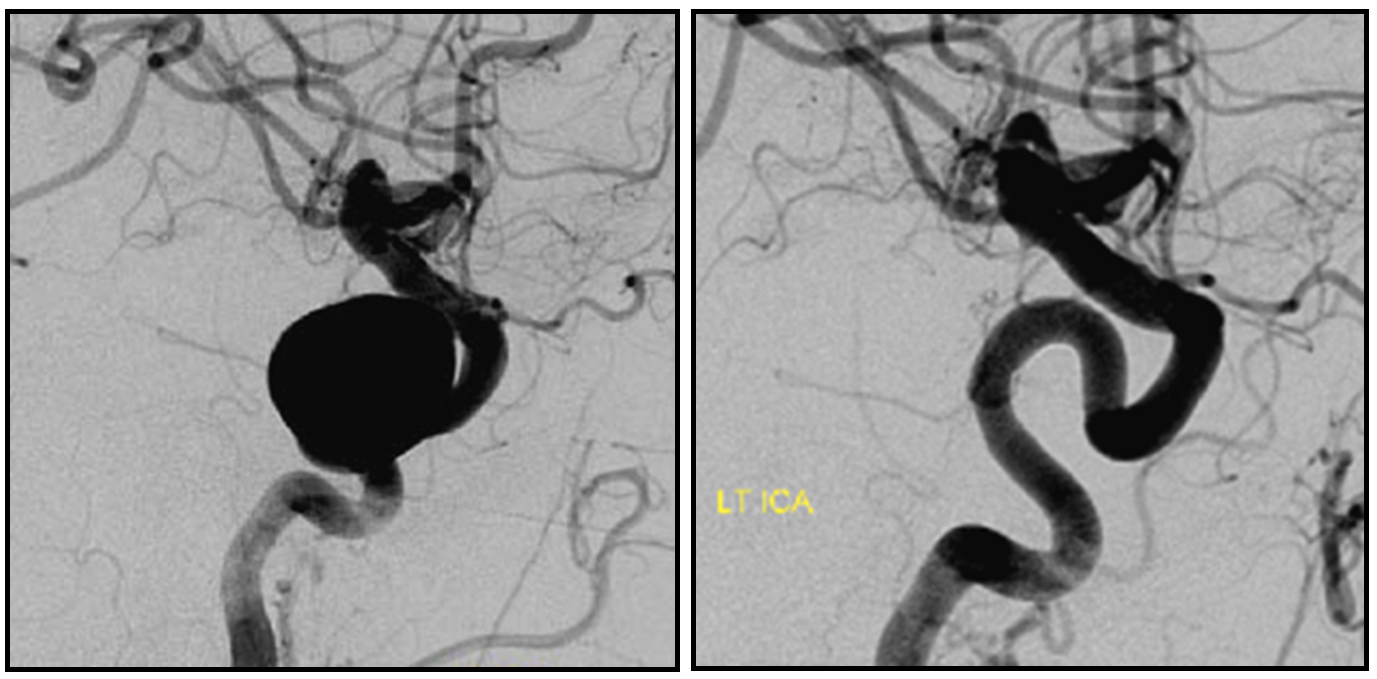 Pipeline Aneurysm Treatment