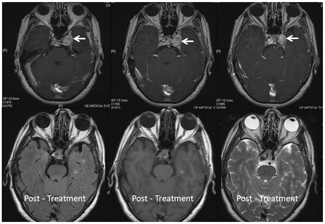 Pipeline Aneurysm Treatment