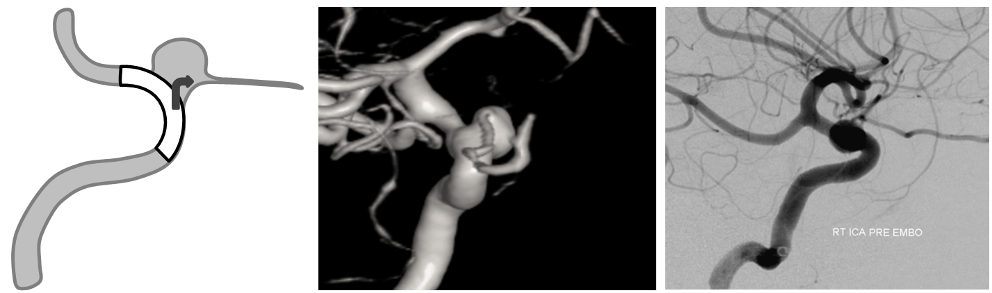 Pipeline Aneurysm Treatment