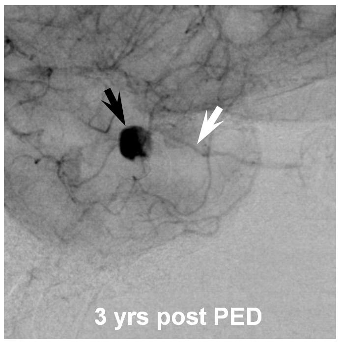 Pipeline Aneurysm Treatment