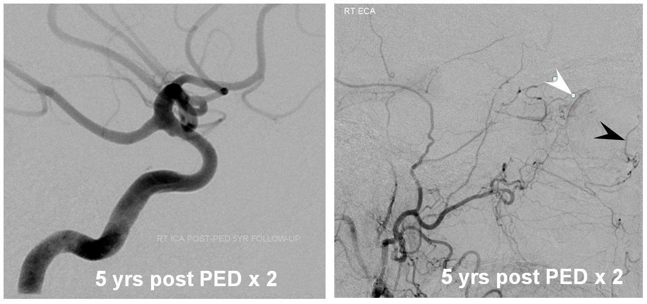 Pipeline Aneurysm Treatment