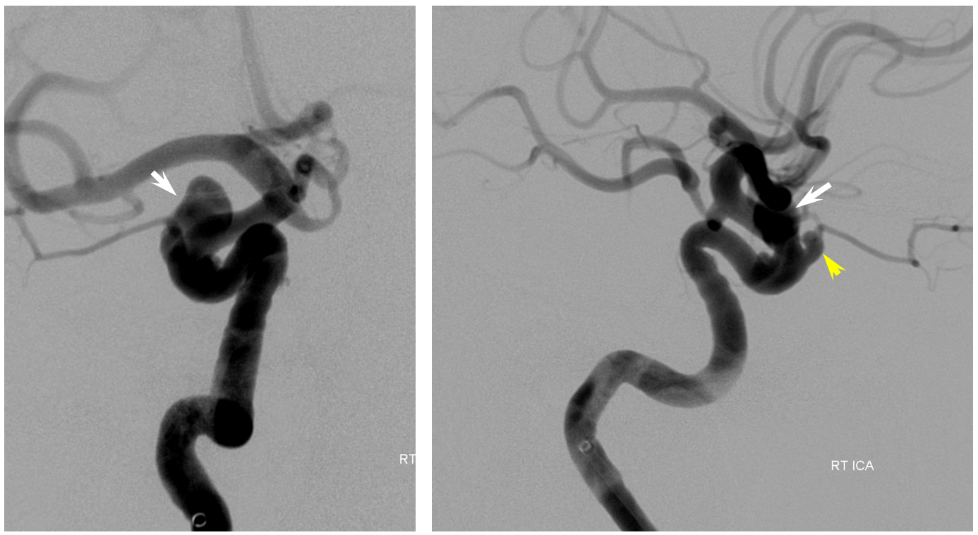 Pipeline Aneurysm Treatment