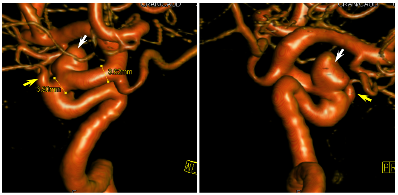 Pipeline Aneurysm Treatment