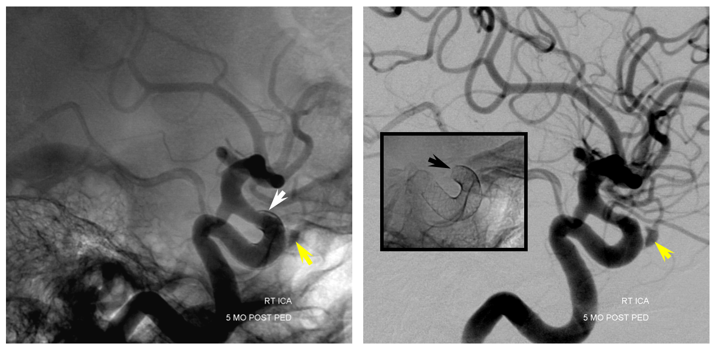 Pipeline Aneurysm Treatment