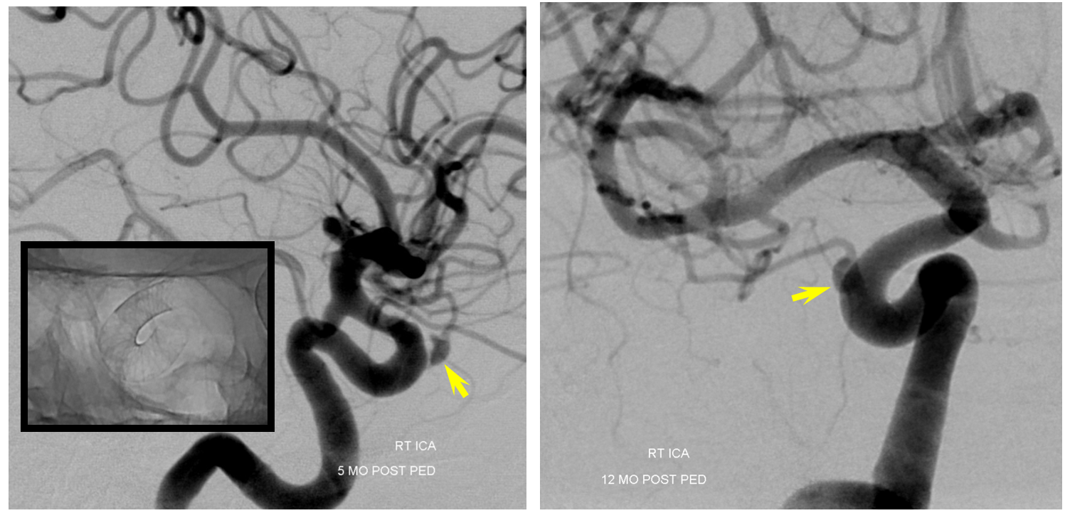 Pipeline Aneurysm Treatment